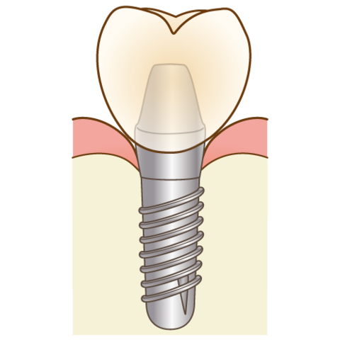 implant-cheap1.png