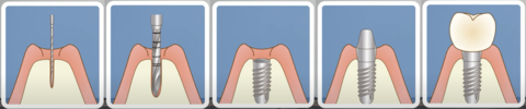 implant-dentures1.png