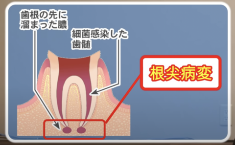 root-canal-treatment1.pngのサムネール画像のサムネール画像のサムネール画像