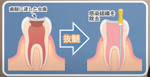 root-canal-treatment2.pngのサムネール画像のサムネール画像