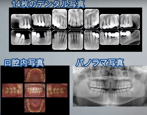 cavity-cause2.png