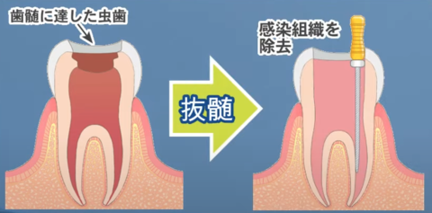 root-canal-treatment-times1.png