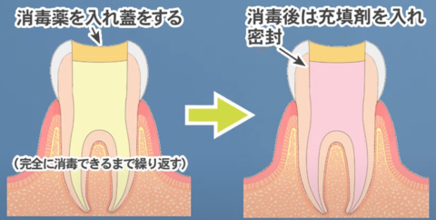 root-canal-treatment-times2.png