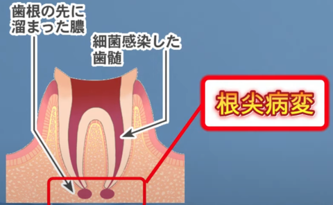 root-canal-treatment-times3.png