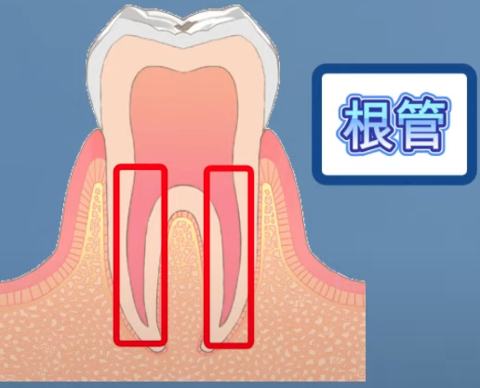 root-canal-treatment-times4.png