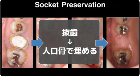 socket-preservation2.png