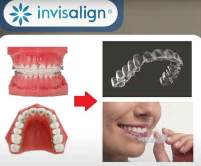 orthodontics-mouthpiece1.png