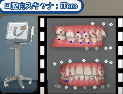 orthodontics-mouthpiece2.png