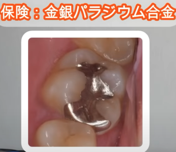 silver-teeth-ceramic4.png