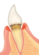 歯周病の進行と治療法