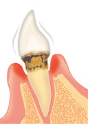 歯周病の進行と治療法